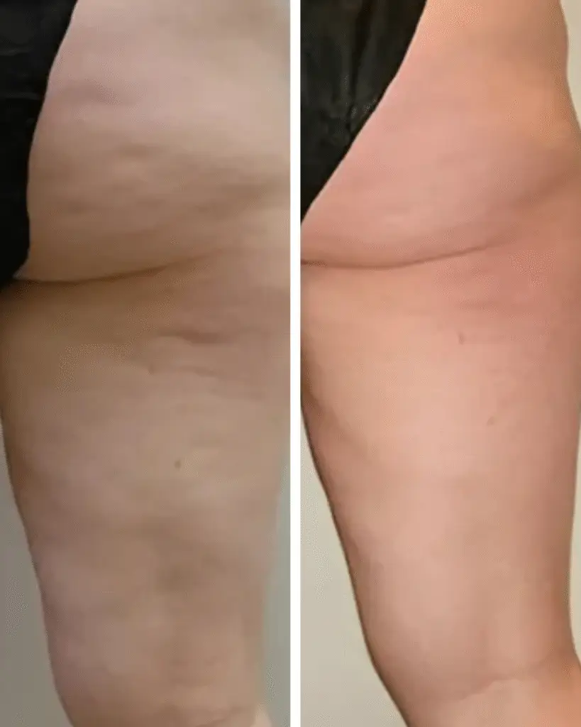 Before and after cellulite treatment on thighs.