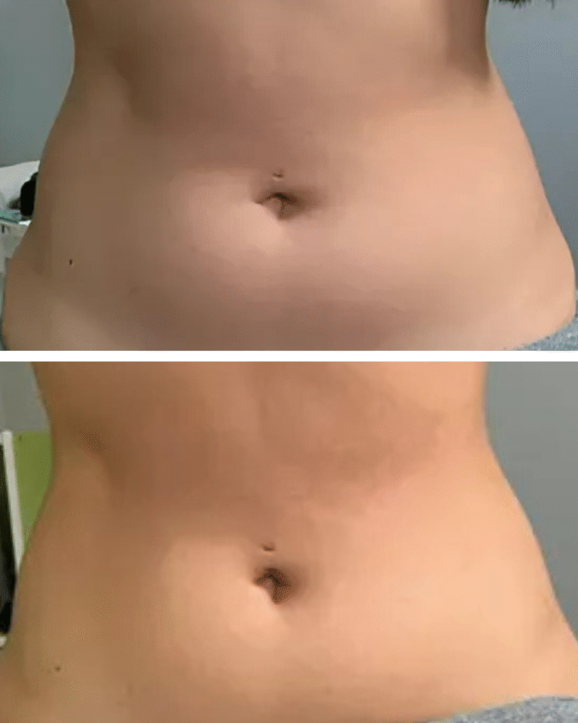 Before and after weight loss stomach comparison.