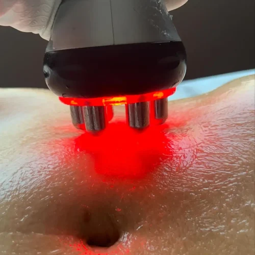 Laser therapy on skin with red light device.